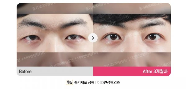 Non-Incisional Double Eyelid Surgery before-and-after photo, before surgery - TheLINE Plastic Surgery