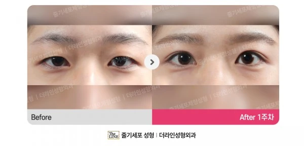 Non-Incisional Double Eyelid Surgery before-and-after photo, before surgery - TheLINE Plastic Surgery