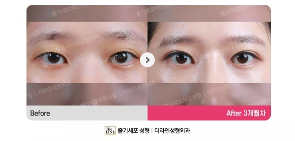 Non-Incisional Double Eyelid Surgery before-and-after photo, before surgery - TheLINE Plastic Surgery