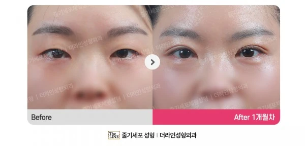 Incisional Double Eyelid Surgery before-and-after photo, before surgery - TheLINE Plastic Surgery