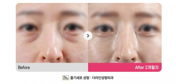 Lower Blepharoplasty before-and-after photo, before surgery - TheLINE Plastic Surgery