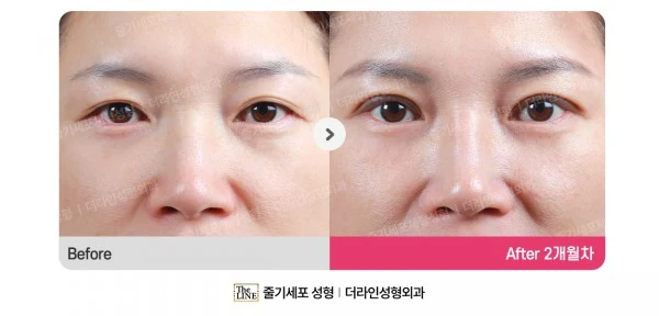 Incision before-and-after photo, before surgery - TheLINE Plastic Surgery