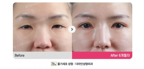 Incision before-and-after photo, before surgery - TheLINE Plastic Surgery