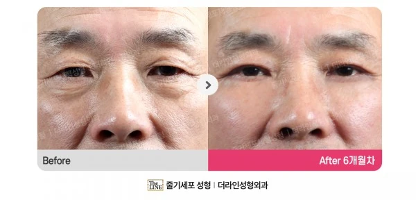 Lower Blepharoplasty before-and-after photo, before surgery - TheLINE Plastic Surgery