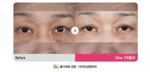 Lower Blepharoplasty before-and-after photo, before surgery - TheLINE Plastic Surgery