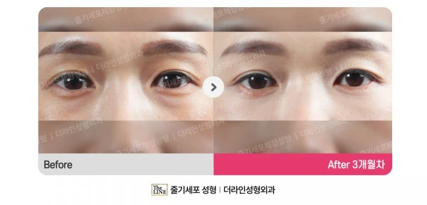 Lower Blepharoplasty before-and-after photo, before surgery - TheLINE Plastic Surgery