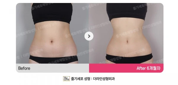 Abdominal Liposuction, Hip Fat Grafting before-and-after photo, before surgery - TheLINE Plastic Surgery