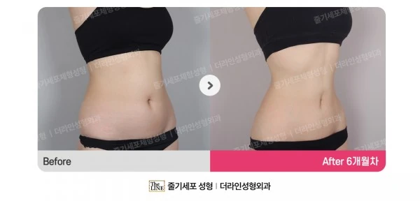 Abdominal Liposuction, Hip Fat Grafting before-and-after photo, before surgery - TheLINE Plastic Surgery
