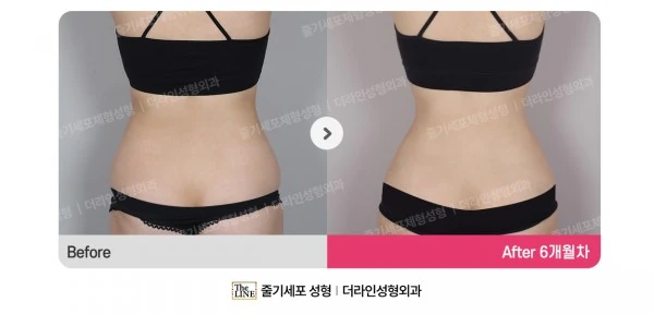 Abdominal Liposuction, Hip Fat Grafting before-and-after photo, before surgery - TheLINE Plastic Surgery