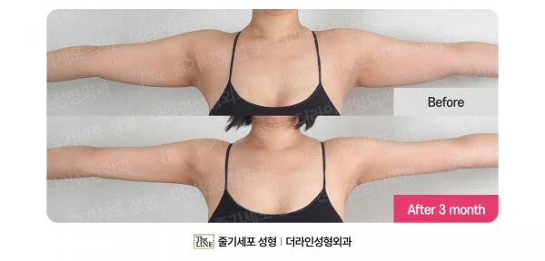 Arm Liposuction before-and-after photo, before surgery - TheLINE Plastic Surgery