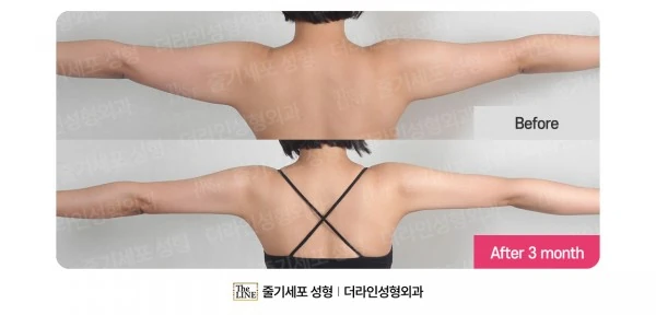 Arm Liposuction before-and-after photo, before surgery - TheLINE Plastic Surgery