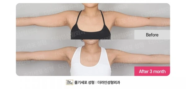 Arm Liposuction before-and-after photo, before surgery - TheLINE Plastic Surgery