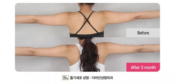Arm Liposuction before-and-after photo, before surgery - TheLINE Plastic Surgery
