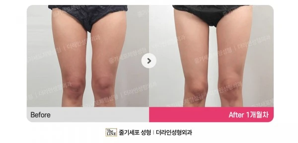 Thigh Liposuction before-and-after photo, before surgery - TheLINE Plastic Surgery