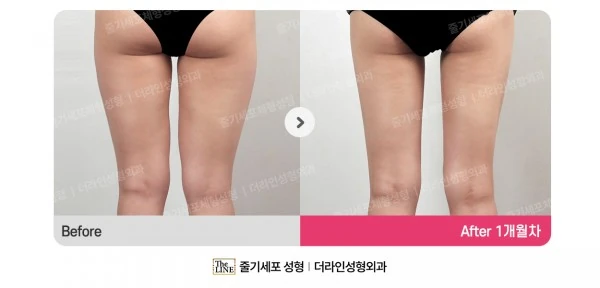 Thigh Liposuction before-and-after photo, before surgery - TheLINE Plastic Surgery