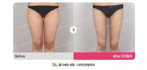 Thigh Liposuction before-and-after photo, before surgery - TheLINE Plastic Surgery