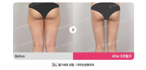 Thigh Liposuction before-and-after photo, before surgery - TheLINE Plastic Surgery
