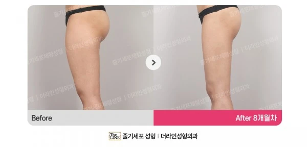 Thigh Liposuction before-and-after photo, before surgery - TheLINE Plastic Surgery