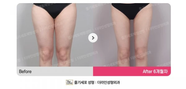 Thigh Liposuction before-and-after photo, before surgery - TheLINE Plastic Surgery