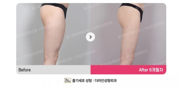 Thigh Liposuction before-and-after photo, before surgery - TheLINE Plastic Surgery