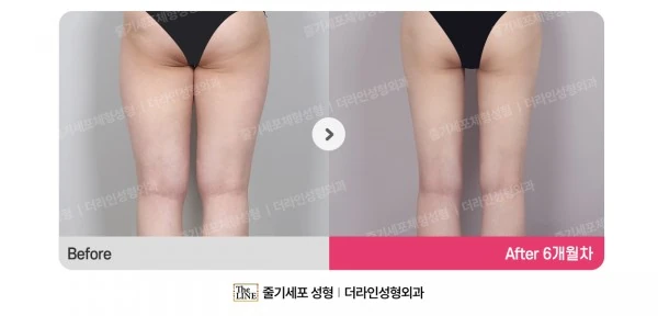 Thigh Liposuction before-and-after photo, before surgery - TheLINE Plastic Surgery