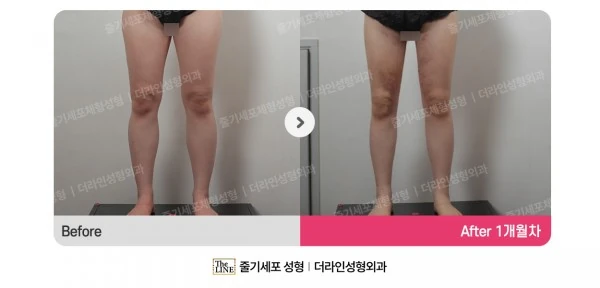 Thigh Liposuction before-and-after photo, before surgery - TheLINE Plastic Surgery