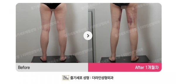 Thigh Liposuction before-and-after photo, before surgery - TheLINE Plastic Surgery