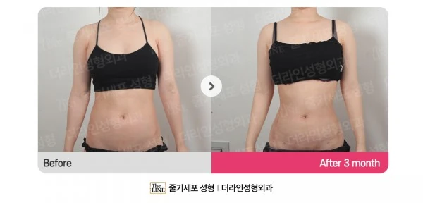 Abdominal Liposuction before-and-after photo, before surgery - TheLINE Plastic Surgery