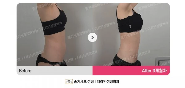 Abdominal Liposuction before-and-after photo, before surgery - TheLINE Plastic Surgery