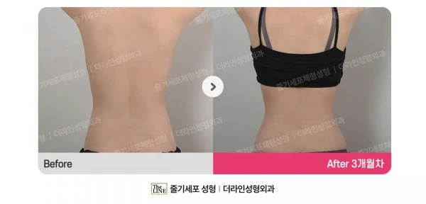 Abdominal Liposuction before-and-after photo, before surgery - TheLINE Plastic Surgery