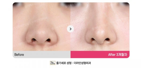 Barbie Nose before-and-after photo, before surgery - TheLINE Plastic Surgery