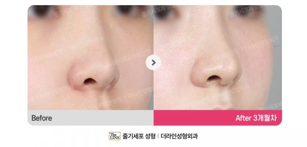 Barbie Nose before-and-after photo, before surgery - TheLINE Plastic Surgery