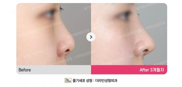 Barbie Nose before-and-after photo, before surgery - TheLINE Plastic Surgery