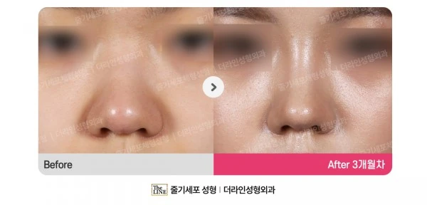 Barbie Nose before-and-after photo, before surgery - TheLINE Plastic Surgery