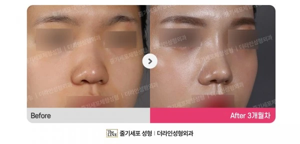 Barbie Nose before-and-after photo, before surgery - TheLINE Plastic Surgery