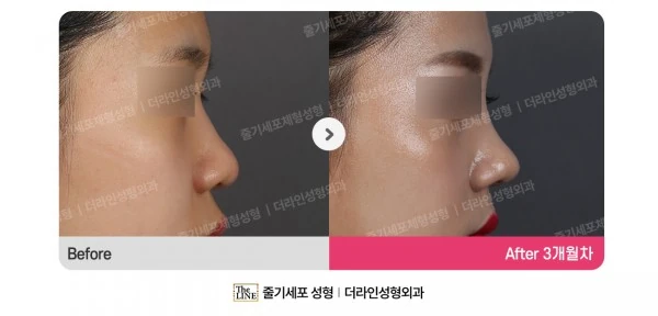 Barbie Nose before-and-after photo, before surgery - TheLINE Plastic Surgery