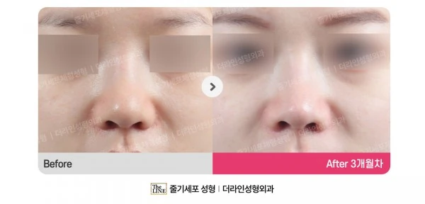 Barbie Nose before-and-after photo, before surgery - TheLINE Plastic Surgery