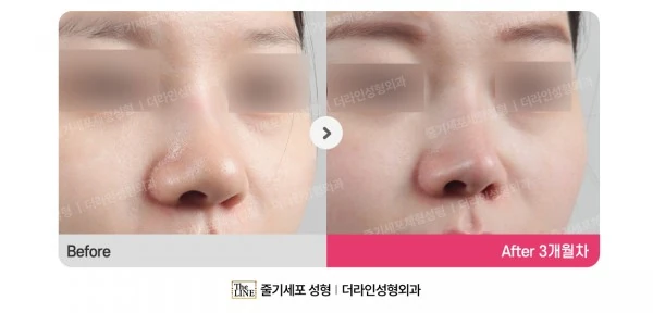 Barbie Nose before-and-after photo, before surgery - TheLINE Plastic Surgery