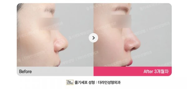 Barbie Nose before-and-after photo, before surgery - TheLINE Plastic Surgery