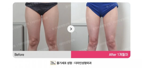 Thigh Liposuction before-and-after photo, before surgery - TheLINE Plastic Surgery