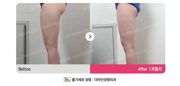 Thigh Liposuction before-and-after photo, before surgery - TheLINE Plastic Surgery