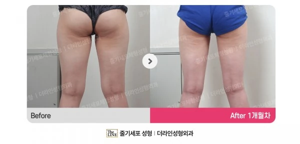Thigh Liposuction before-and-after photo, before surgery - TheLINE Plastic Surgery