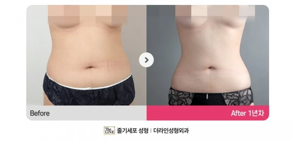 Abdominal Liposuction before-and-after photo, before surgery - TheLINE Plastic Surgery