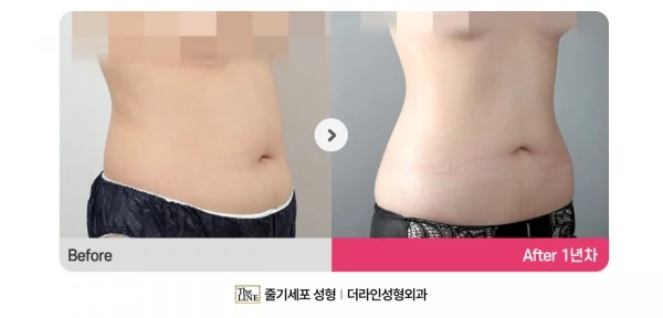Abdominal Liposuction before-and-after photo, before surgery - TheLINE Plastic Surgery