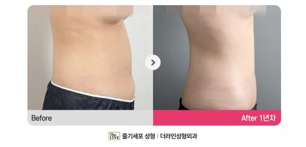 Abdominal Liposuction before-and-after photo, before surgery - TheLINE Plastic Surgery