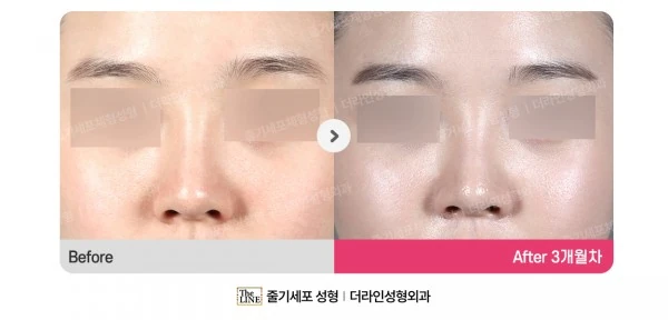Barbie Nose before-and-after photo, before surgery - TheLINE Plastic Surgery