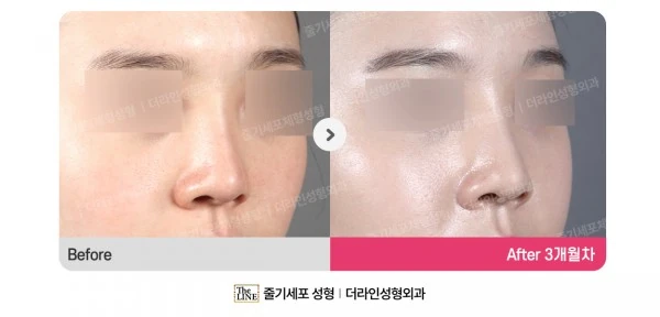 Barbie Nose before-and-after photo, before surgery - TheLINE Plastic Surgery