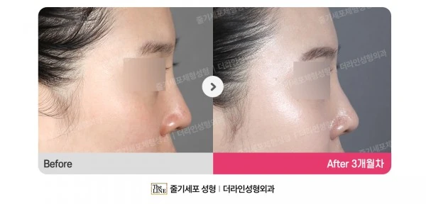 Barbie Nose before-and-after photo, before surgery - TheLINE Plastic Surgery