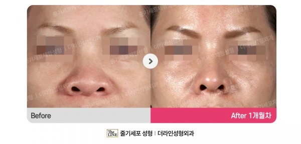 Alar Reduction before-and-after photo, before surgery - TheLINE Plastic Surgery