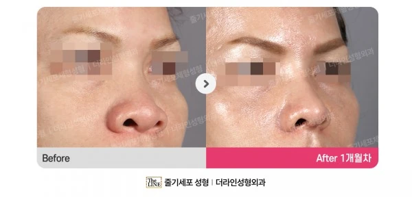 Alar Reduction before-and-after photo, before surgery - TheLINE Plastic Surgery